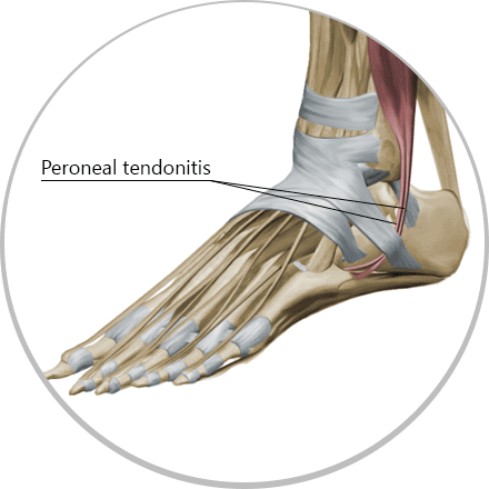 Treat peroneal tendonitis