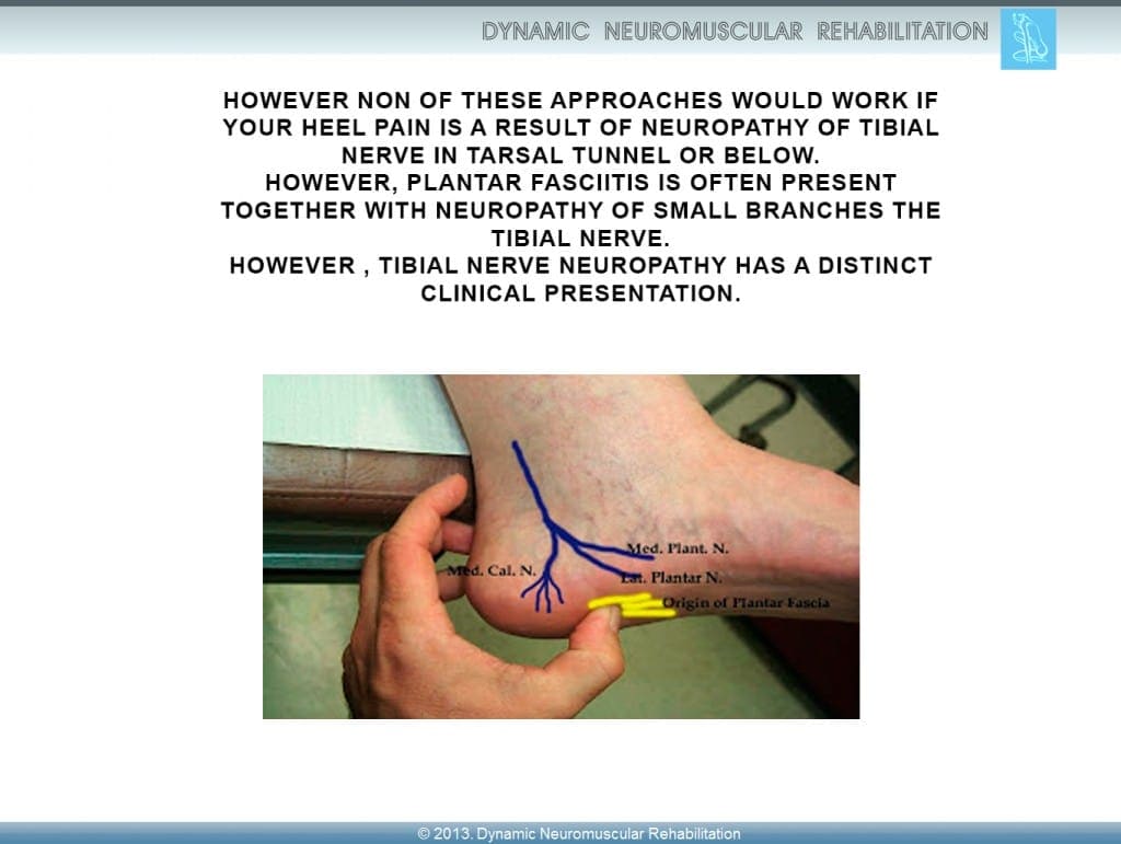 plantar neuroma