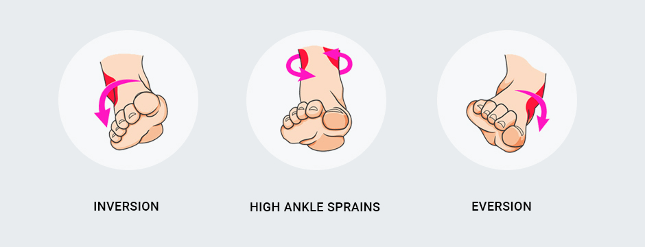 There are three basic types of ankle sprains