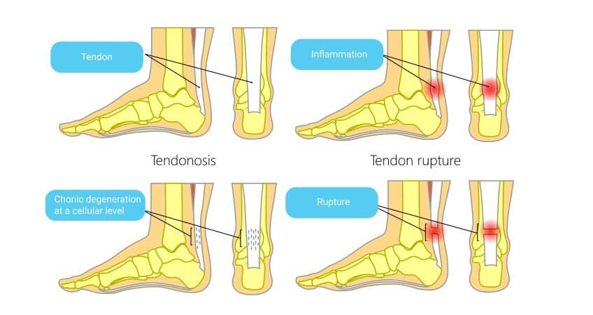 Healing And Rehabbing Hip Flexor Tendinosis NYDNRehab