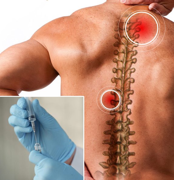Why Back Pain Physical Therapy