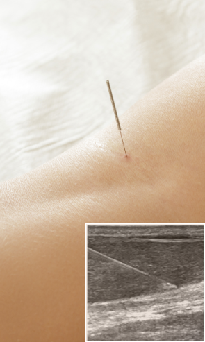 Ultrasound Guided Dry Needling of the Patellar Tendon