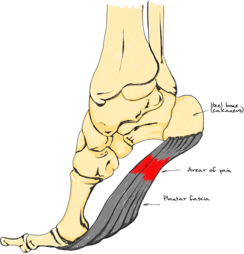 Heel Spurs and Other Types of Foot Pain