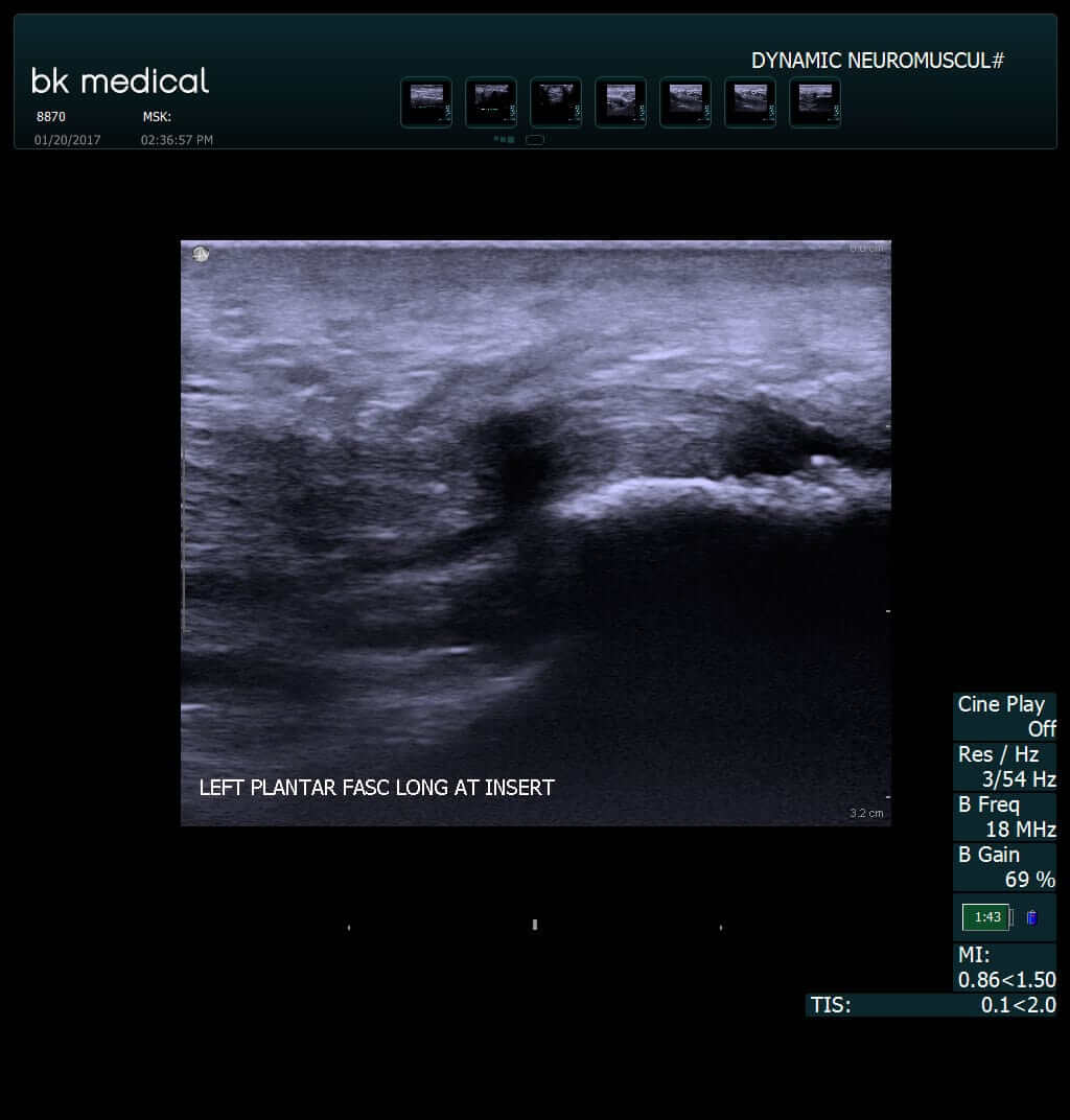 How to Treat Plantar Fasciitis, Runner�s Heel and Heel Pain