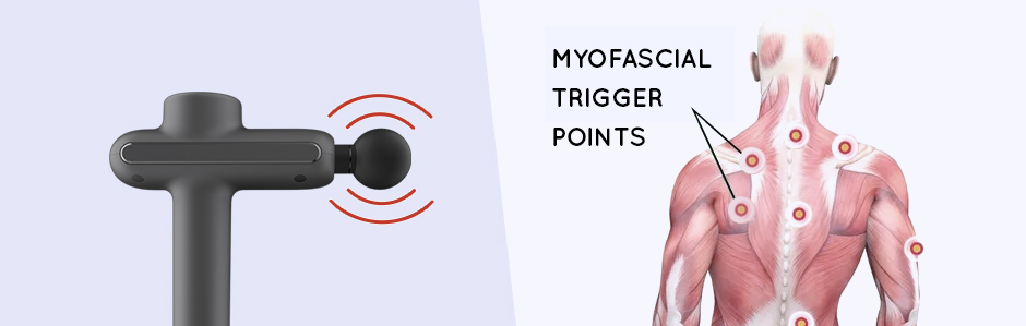 Myofascial Trigger Points