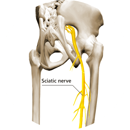 What Is Sciatica? How to Treat Sciatica Conditions? Physical Therapy ...