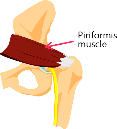 Piriformis syndrome hip pain