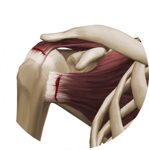 Why rotator cuff tendinopathies occur