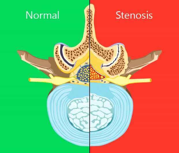 Spinal stenosis treatment in New York