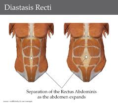 Diastasis Recti: a woman with the condition (abdomen expanded) and a woman without it.