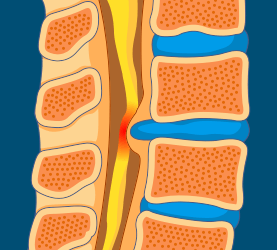 Sciatica Pain Physical Therapy Treatment NYC - DNRehab PT specialist