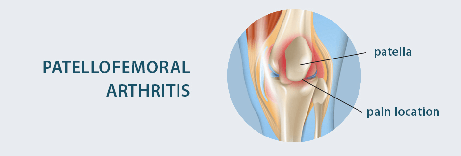 Symptoms of knee pain