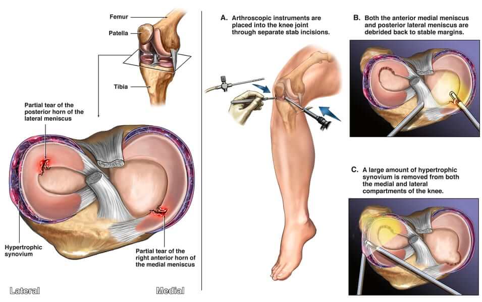 Ana<tome of meniscus. Meniscal tears in the knee