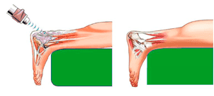 shockwave treatment of achillodynia