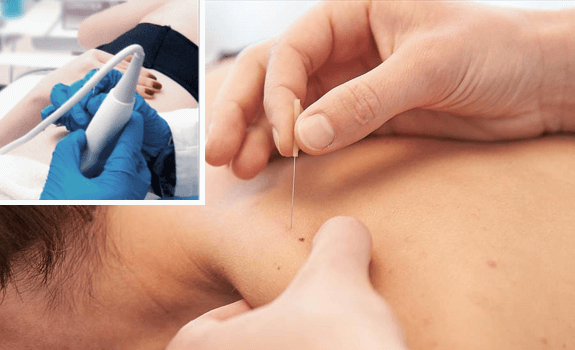 Ultrasound guided dry needling