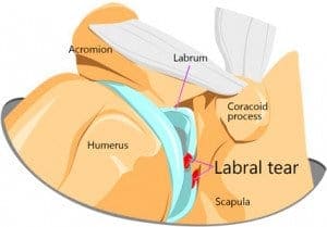 Labral tears