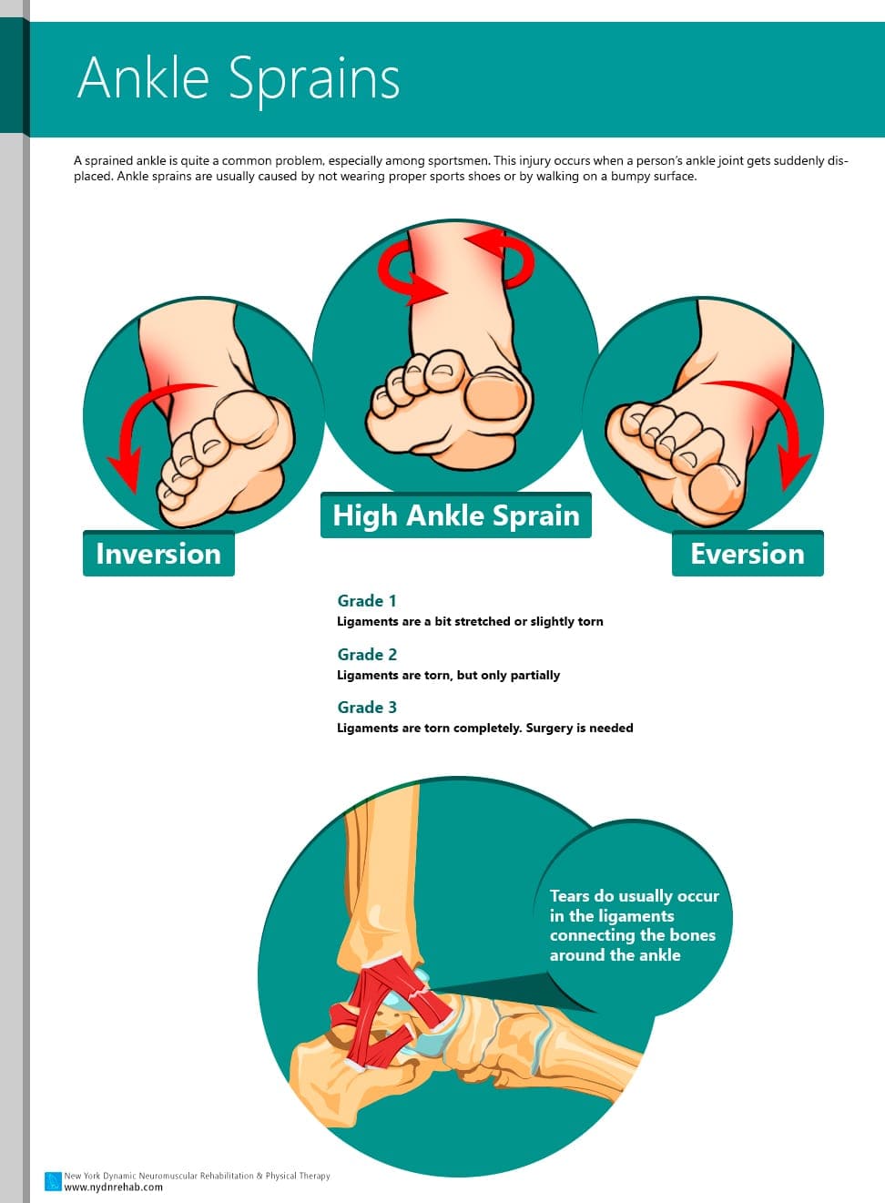 Ankle Sprain Grades