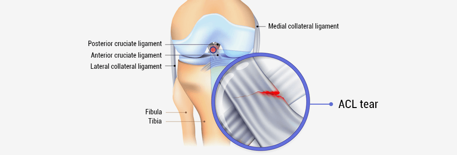 ACL Injury - The Comprehensive Guide to Anterior Cruciate Ligament Tear &  Sprain!