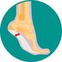 Shockwave Therapy for Heel Pain