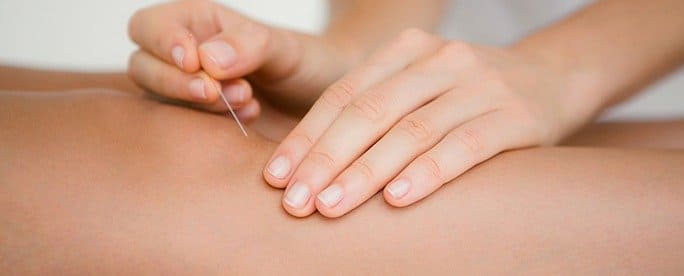 Dry Needling Therapy in NYC