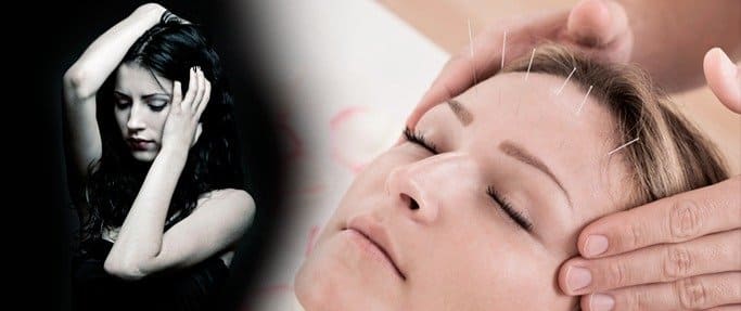 acupuncture for migraines