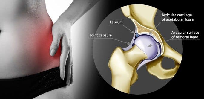 Understanding Hip And Groin Pain