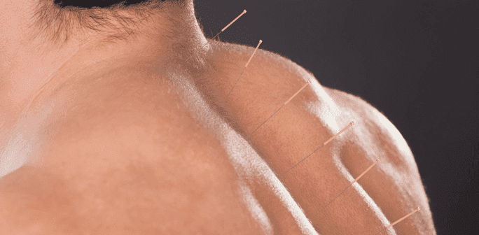 acupuncture for back pain