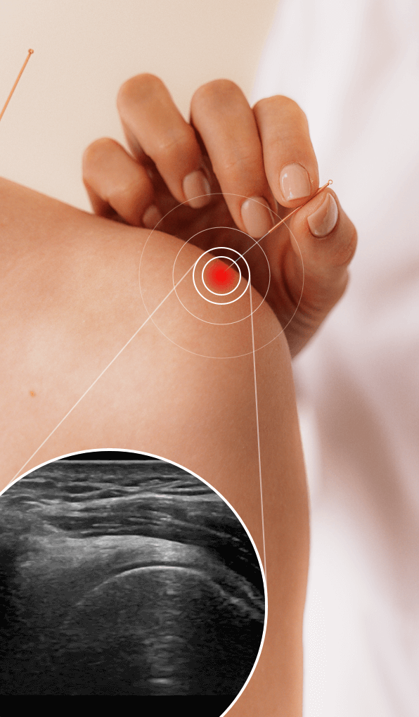 The Ultrasound Guided Dry Needling Procedure