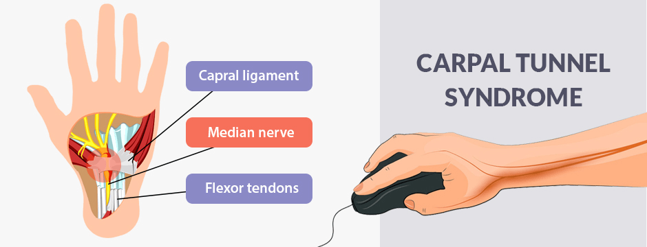 Top Tips for Carpal Tunnel Syndrome Prevention