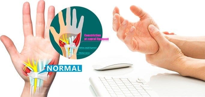 5 Important Exercises For Relief Of Carpal Tunnel Syndrome