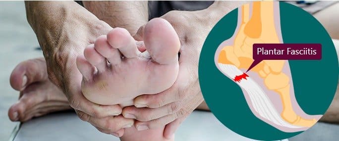 plantar fasciitis