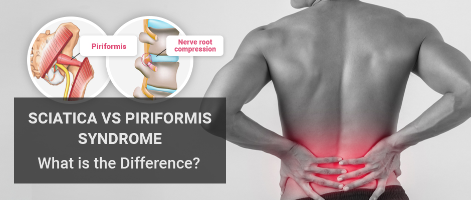  Sciatica versus Piriformis Syndrome: What is the Difference?
