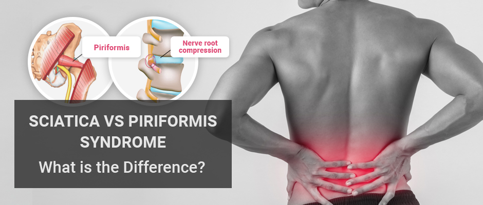 Piriformis Syndrome Test - Is Piriformis Your Pain Source?