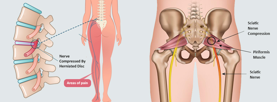 Piriformis Syndrome (entrapment of the sciatic nerve causing sciatica)