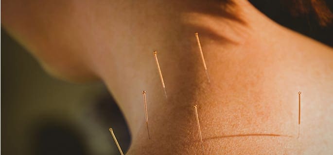 Acupuncture treatment