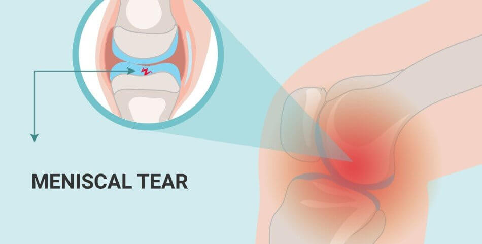 What-does-torn-meniscus-look-like