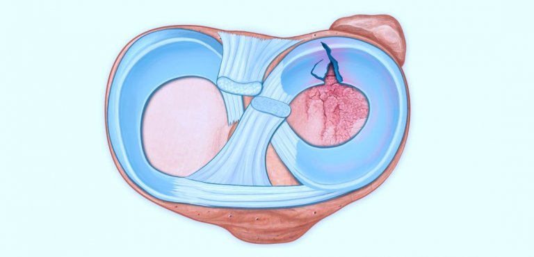 what-does-torn-meniscus-look-like