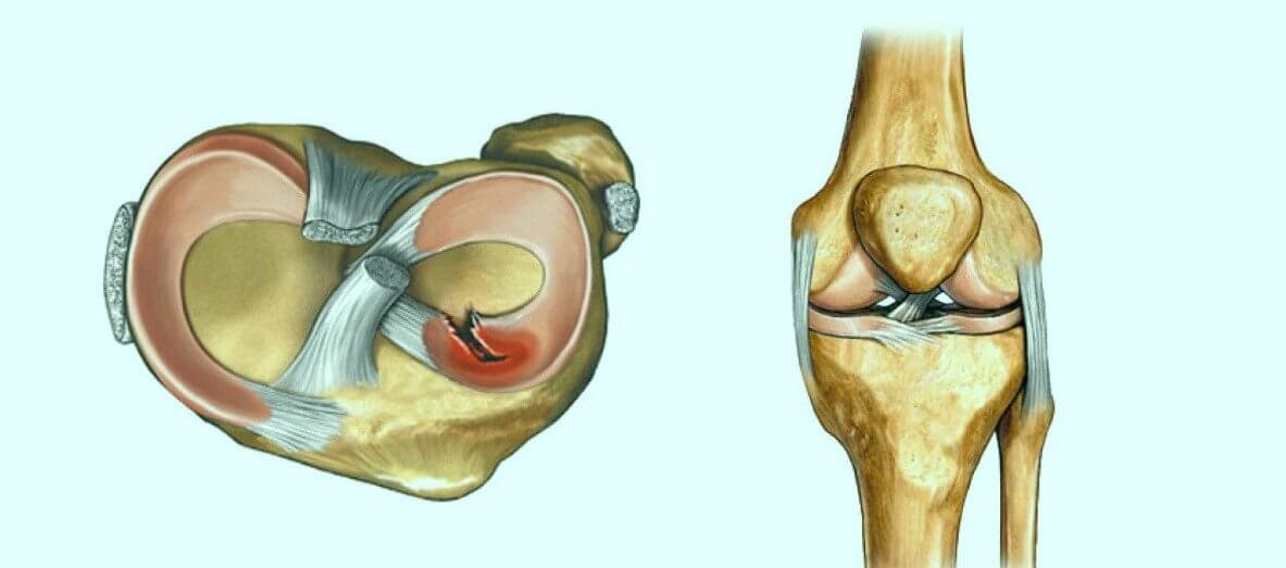 Causes Behind Tearing of the Meniscus