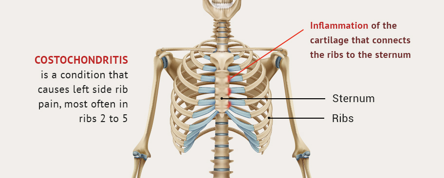 Getting To The Bottom Of Rib Cage Pain