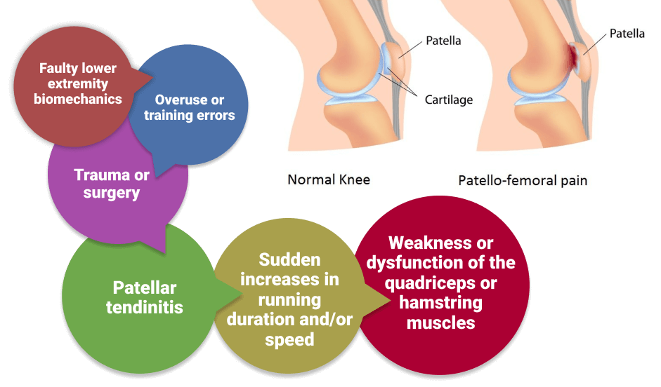 Patella Dysfunction 