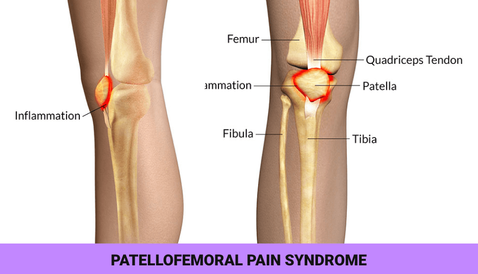 Running style tips that can help Patello-Femoral pain (Runner's Knee)