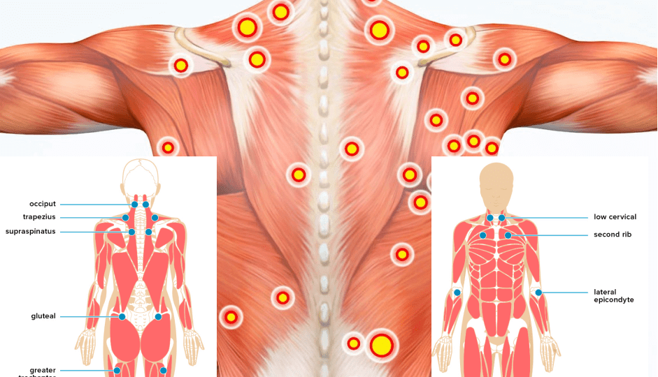 Myofascial Trigger Points and Back Pain - Propel Physiotherapy