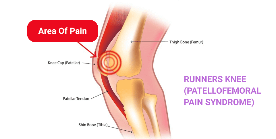 How Chiropractic Can Help Patellofemoral Tracking Syndrome