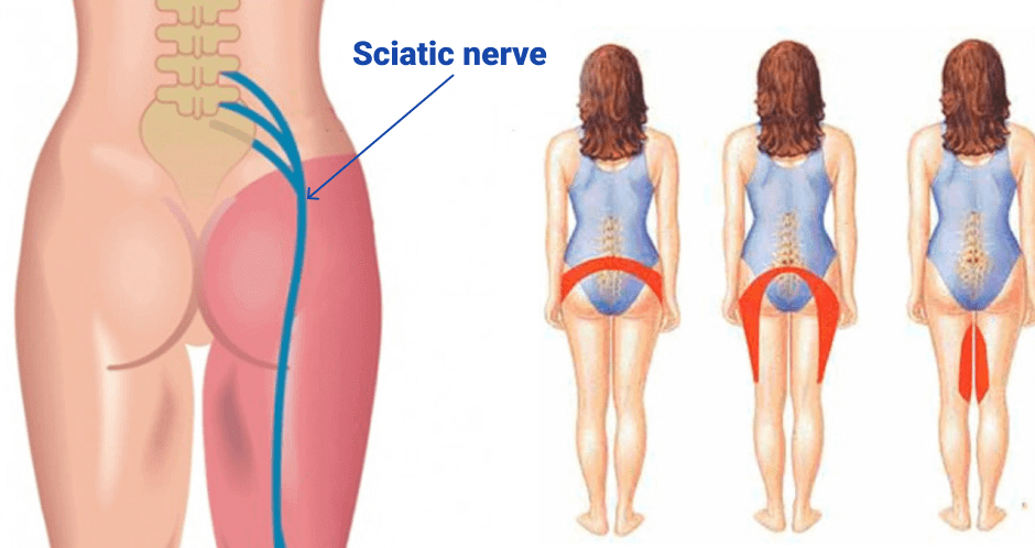 Sciatica Symptoms, Diagnosis, and Treatments - Blog