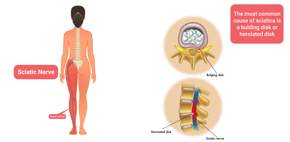 Sciatica Pain Relief - Anatomy & Definition — Revive Sport & Spine