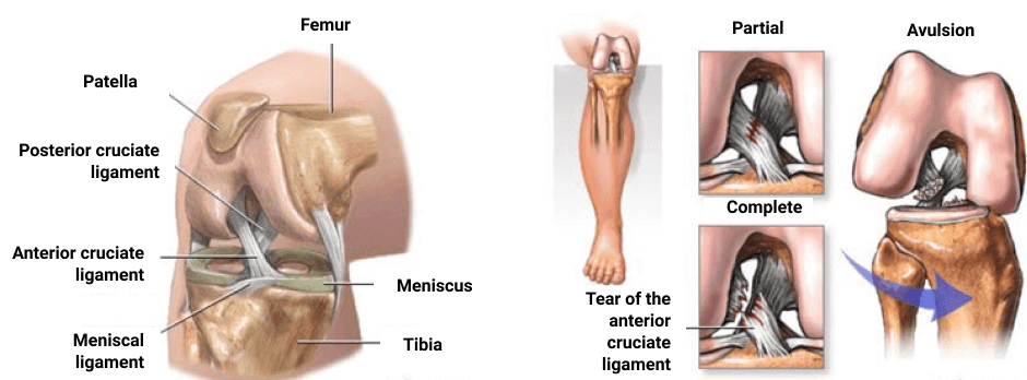 Anterior Cruciate Ligament (ACL) Tears (for Parents)