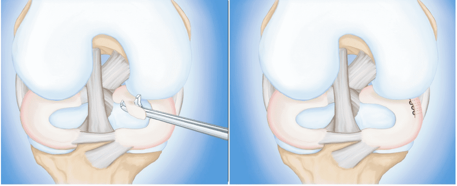 Diagnosis of a Meniscus Tear