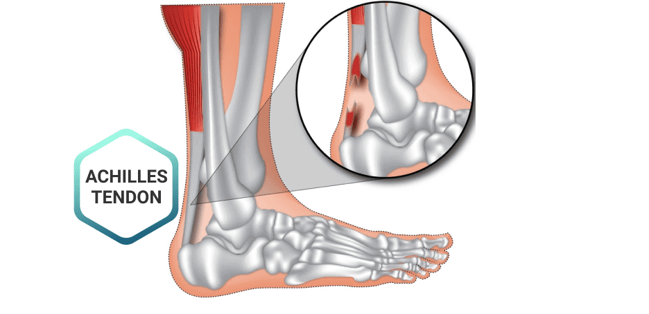 Tendon Injury Diagnosis