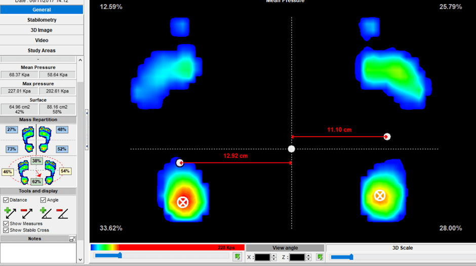 The Role of Gait Analysis