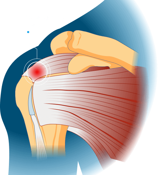 Rotator Cuff Tear Treatment and Rehab